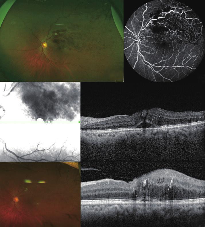 Fundus photography revealed a characteristic flame-shaped retinal hemorrhage in a cone-shape around the superior arcade (A).