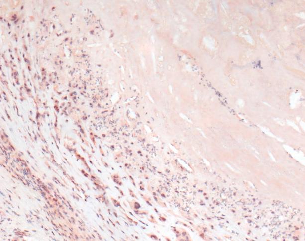 intenzitet bojenja više od 25% stanica), Slika 4.2-1. A B Slika 4.2-1. Imunohistokemija za endotelnu lipazu (primjeri tipa A i B).