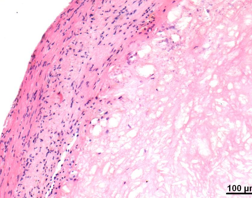 Slika 4.2-2. Histologija - fibrozni plak (Hemalaun-Eozin). Vidi se fibrozna kapa (prazne strelice) glatke površine i bez ulceracija, te nekrotična srž (pune strelice).