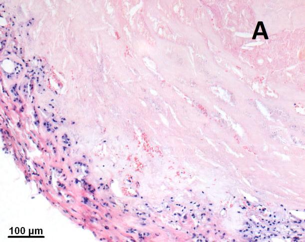 sloju i u stanicama unutar fibrozne kape. Fibrozna kapa također ima umjereno CD163 imunobojanje što ukazuje na prisustvo monocita i makrofaga.