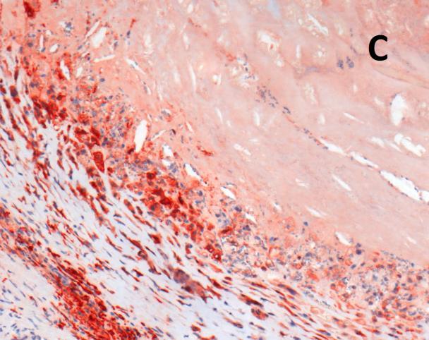 pokazuju snažno CD163 imunobojanje odnosno gdje se dominantno nalaze makrofazi, Slika 4.2-4. Slika 4.2-4. Lokalizacija endotelne lipaze u karotidnom plaku.