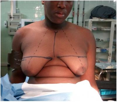 seroma at the level of the right breast, resolving with a puncture using a catheter and a partial bilateral