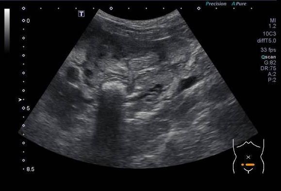 Step 2 Abdominal Ultrasound Ultrasound Findings: The bladder wall is diffusely moderately thickened with retention of normal wall layering. Wall thickness up to 6.1mm.