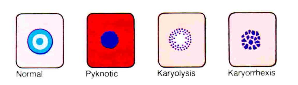 Fundamental changes 1Nuclear changes: Pyknosis, karyorrhexis,