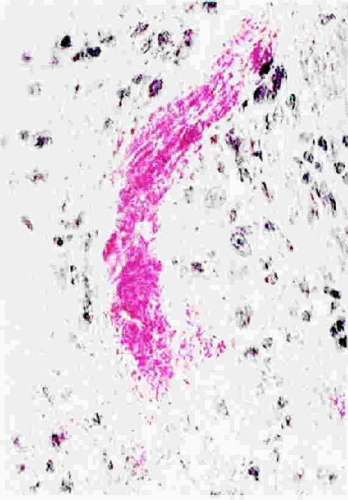 Fibrinoid necrosis(fibrinoid change) Conception: Accumulation of pink staining homogenous masses of fibrin,