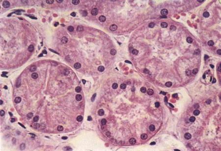 H: Swollen of affected cells, with fine granules and vacuoles filling the cytoplasm.