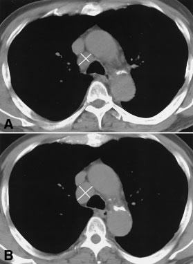 Response Assessment in Renal Cell Carcinoma/Schwartz et al. 1617 lesions. In our series, this group was comprised of patients who still had their primary renal tumors in situ.
