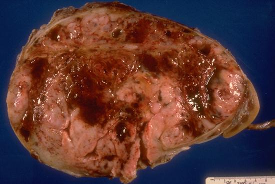 Radical Nephrectromy Performed No Active tumor in kidney or Tumor thrombus All Necrotic
