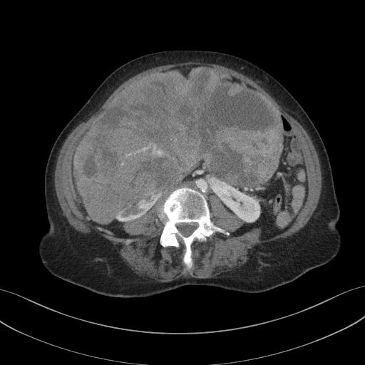 Case # 1-71 F, 20 cm RCC in Horseshoe Kidney