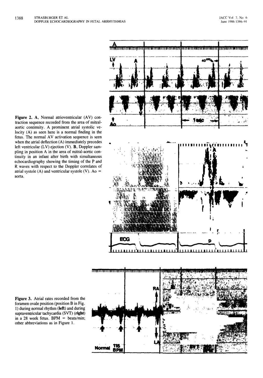1388 STRASBURGER ET AL DOPPLER ECHOCARDIOGRAPHY IN FETAL ARRHYTHMIAS JACe Vol 7, No 6 June 1986 \386--91 Figure 2.