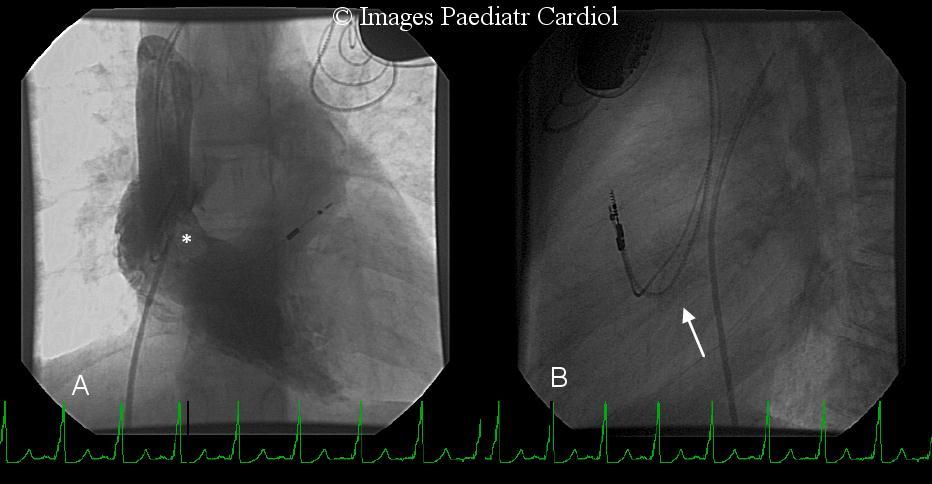 Figure 1: (a) Angiographic evaluation of the right SVC and the right atrial chamber delineating a filling defect (*) within the RA around the leads; (b) Straight lateral fluoroscopic projection