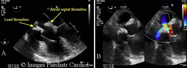 A transesophageal echocardiogram (TEE) confirmed two atrial thrombi; one at the SVC-RA junction associated with the pacing leads, measuring 1. 9 x 0.