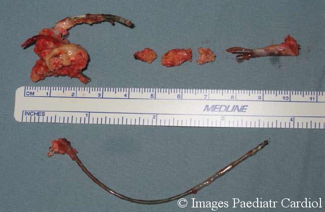 The case was discussed at cardiac surgery conference and one week later she went to the operating room for a right atrial thrombectomy, primary closure of the PFO, and conversion to an epicardial