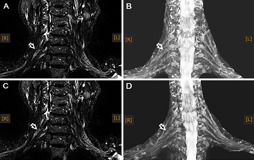 Figure 3. The MR neurography images at 5 days (A, B) and 60 days from the onset of disease (C, D).