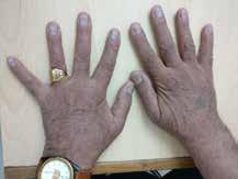 distal interphalangeal joints and asymmetric sacroilitis with raised inflammatory markers. He was allergic to sulphasalazine and intolerant to methotrexate.