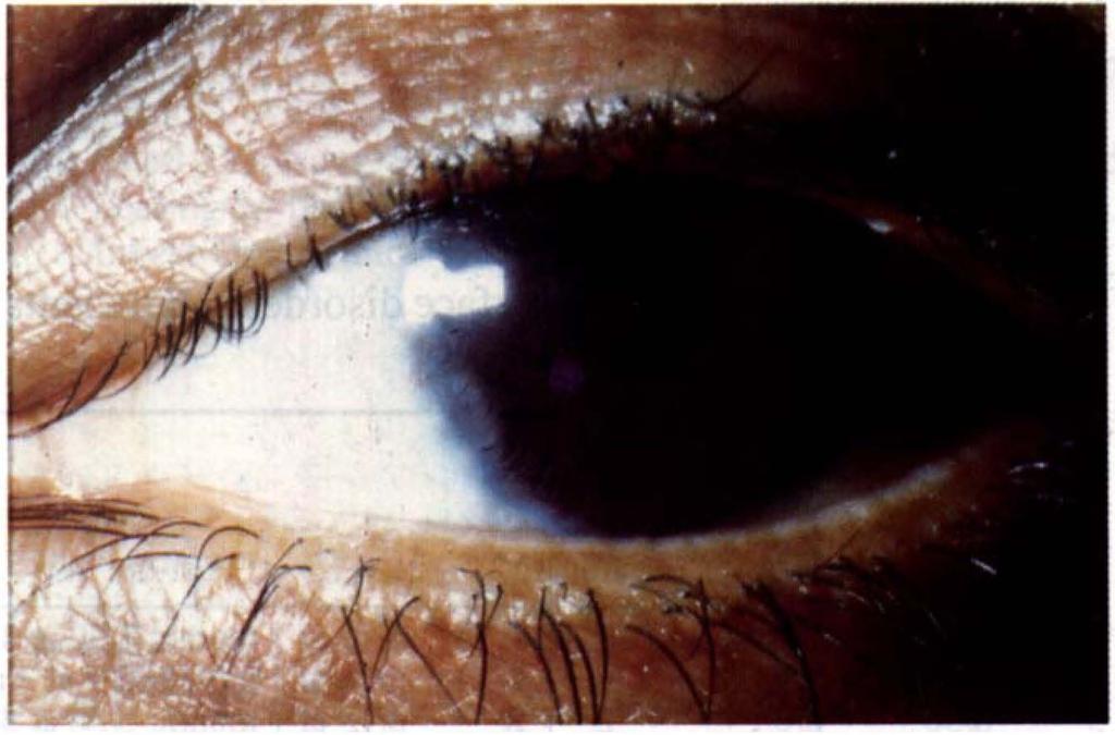 CONTACT LENS EPITHELIOPATHY the left to the right eye, the conjunctiva being harvested from the nasal and temporal limbus.