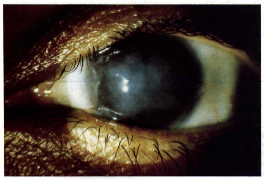 At 3 months, however, the epithelium of this eye had again become irregular, with vortex and fine arcuate punctate epithelial keratitis, and the visual acuity had dropped to 6/36.