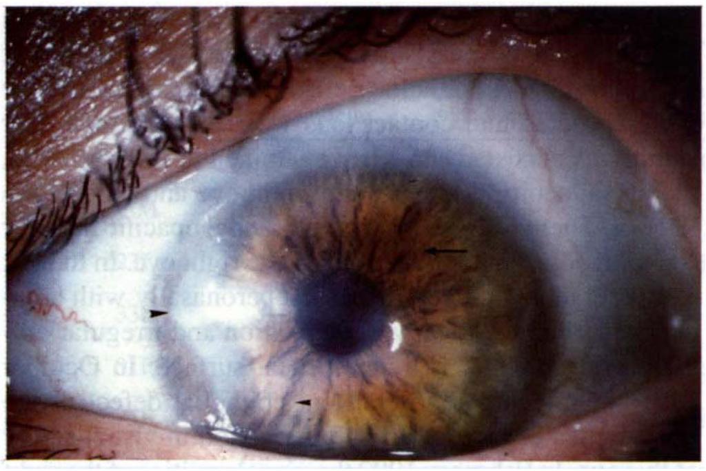 632 C. JENKINS ET AL. Fig. 4. Case 6. Thirty months after discontinuing contact lens wear there is patchy epithelial haze (small arrowhead) with areas o/relatively normal corneal epithelium (arrow).