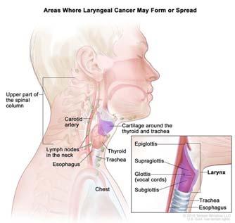 BURDEN OF LARYNX CANCER 21 EPIDEMIOLOGY OF LARYNX CANCER SEER Site Recode: Respiratory Cancers Analyzed in Head & Neck Group (oral + larynx, tobacco associated, or alone stand alone) Rare, 3.