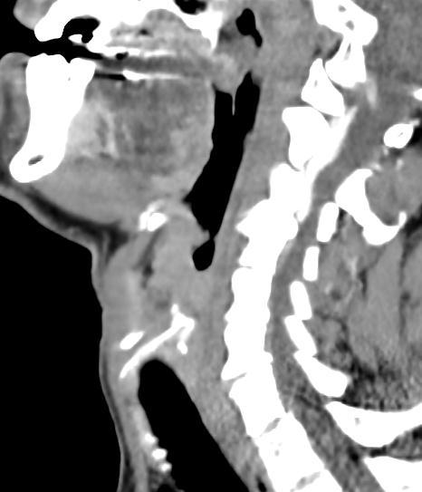 involving left piriform sinus extending to base of tongue and immobile left cord Induction