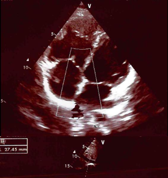 Congenital heart