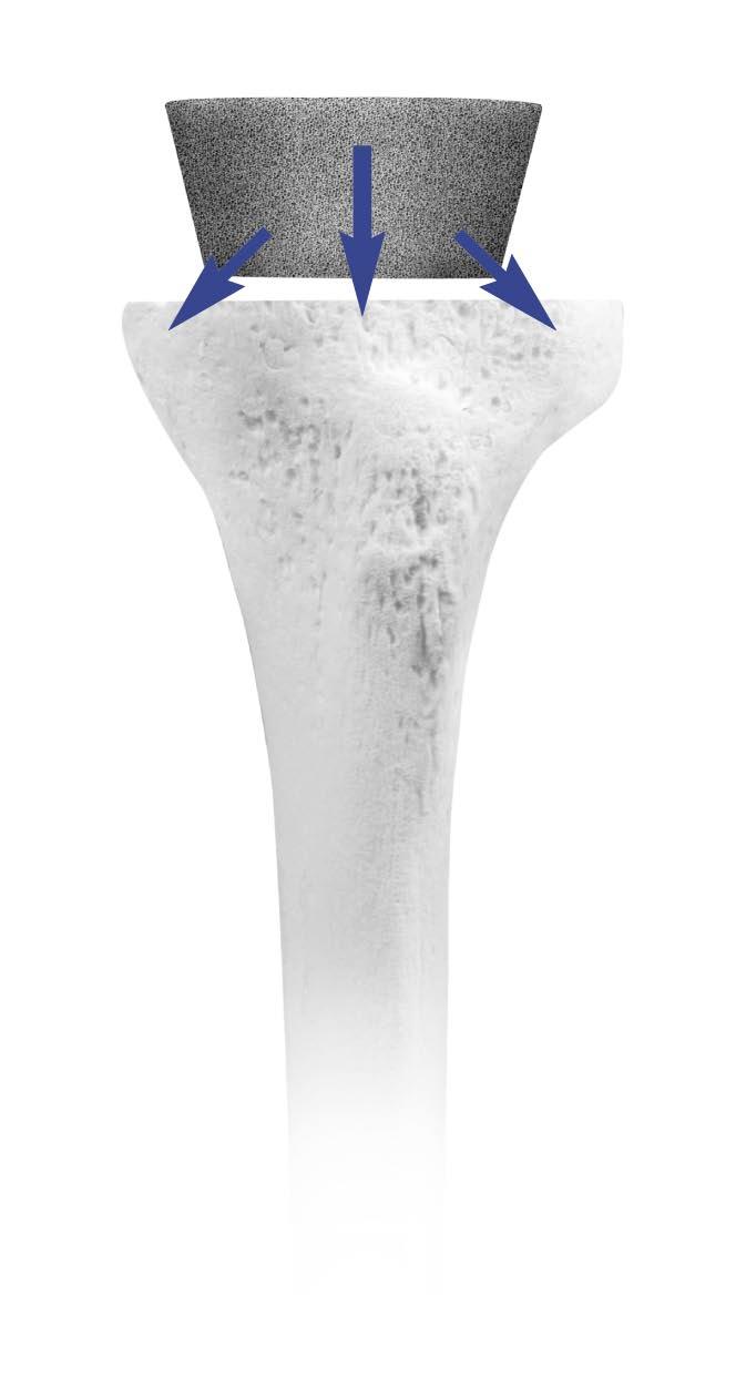 2 Trabecular Metal Cone Overview The objective of using Trabecular Metal Cemented Cone implants is to achieve stability of the construct within the proximal tibia while allowing the compressive