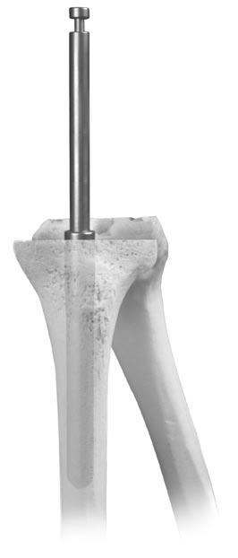 Initial Cone Selection Select a Tibial Cone Augment Provisional component that approximates the size and depth of the defect