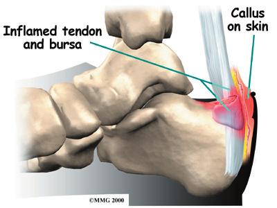 The calcaneus is shaped differently in different people. People who have a prominent bump underneath the attachment of the Achilles tendon are more likely to develop Haglund's deformity.