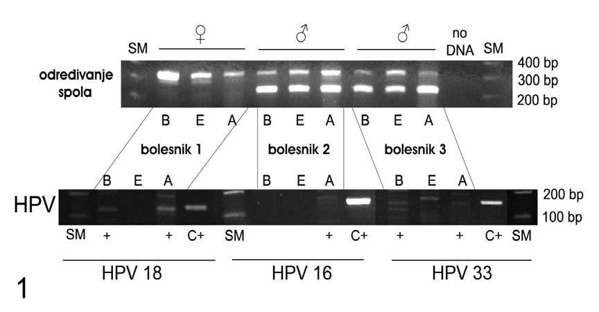 Slika 2. Gel elektroforeza PCR produkata određivanja spola (gornji gel) i detekcije HPV-a (donji gel) dobivenih iz uzoraka izoliranih od pacijenta 1-3.
