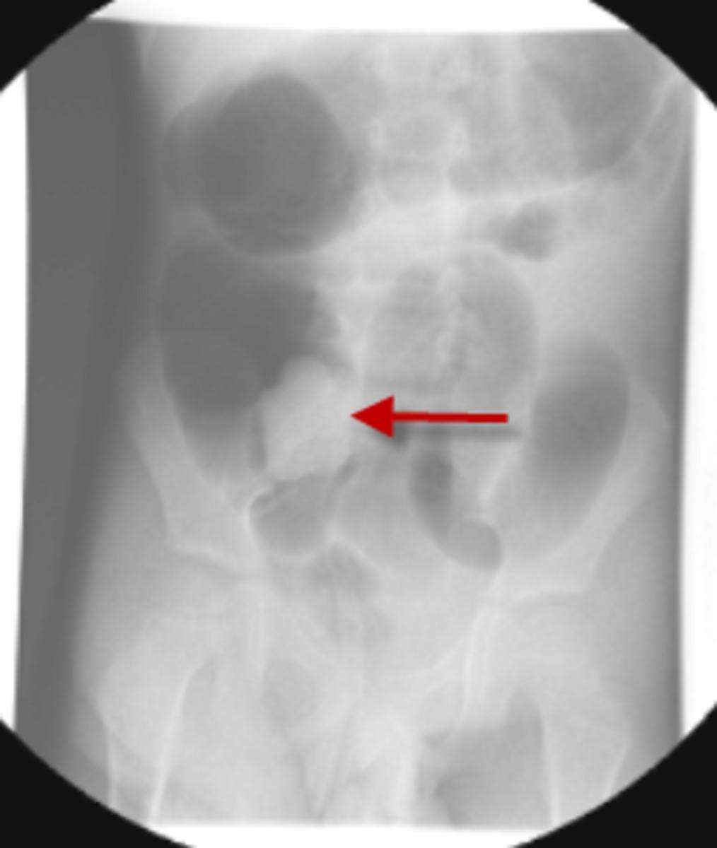 Fig. 2: Fluoroscopy (anteposterior view in supine position) of the