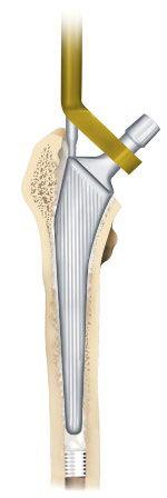 Femoral Stem Insertion A Cement Restrictor is introduced to a depth of 2 cm beyond the tip of the stem.