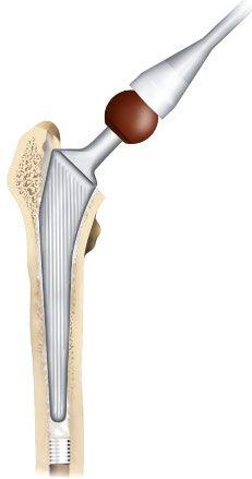Femoral Head Impaction Once the cement is fully set, a further trial reduction is performed.