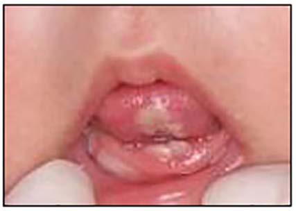 Natal/Neonatal Teeth Natal present at birth. Neonatal within the first 30 days and erupts prior to three months of age.