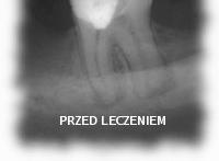 dentin thickness, from the depth of cavity preparation to the