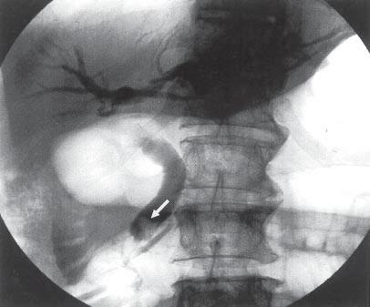 One patient received sphincterectomy and duct exploration because subtle stone was suspected during the contrast injection.