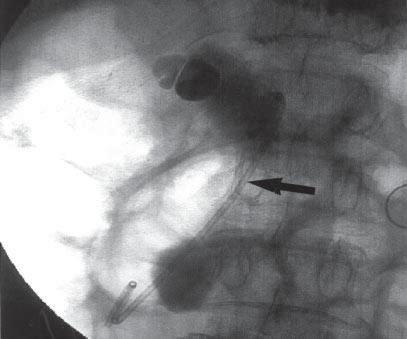 The low signal stone-like lesion was noted in both raw data of 3DTSE RT and sstse BH. ERCP failed due to previous Billroth II subtotal gastrectomy.