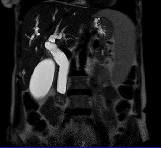 (A) (B) Fig (1) Benign distal CBD stricture in 35- year-old male, with history of recurrent