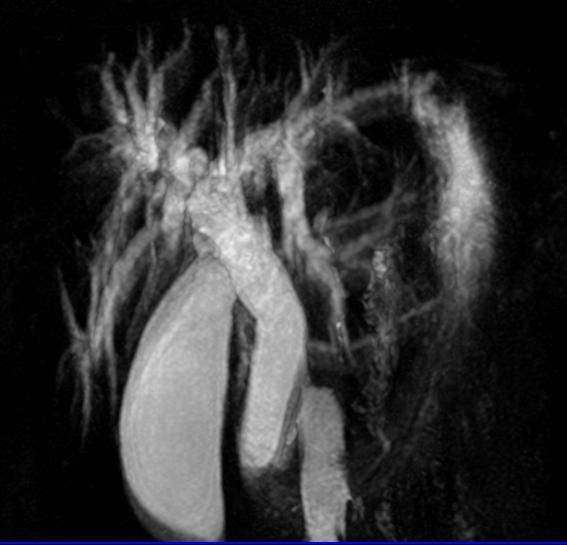 (a) Coronal T2 WI and (b) MRCP revealed significantly dilated IHBR with dilated CBD down to its