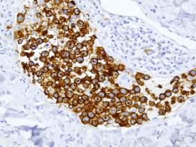 IHC Dogma (also applies in diagnostic haematopathology) IHC complements routine staining Helps characterize cells and