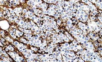 Basic stains: Immunoglobulin B-cell specific Normal κ:λ ratio ca.