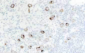 CD30 in lymphoma CD30+ lymphoproliferations : Primary skin anaplastic large cell lymphoma (ALCL) Systemic ALCL Lymphomatoid papulosis Mycosis fungoides transformation Hodgkin