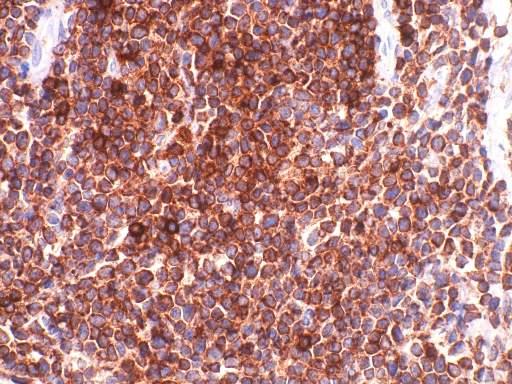 CD3 in lymphoma >90% peripheral TCLs Primitive precursor T-LB in cytoplasm B-cell