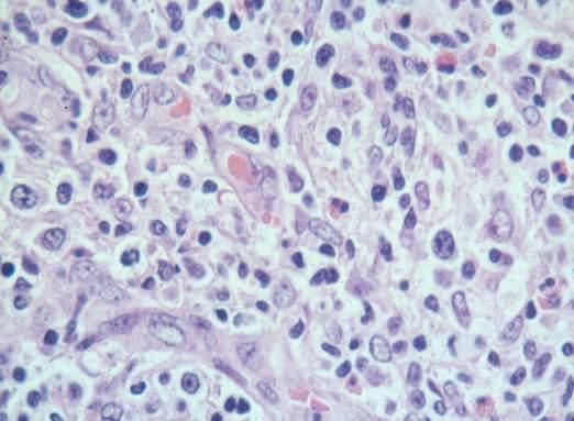 C3d/EBV receptor In lymphomas: most follicular lymphomas some other B-cell NHL FDC