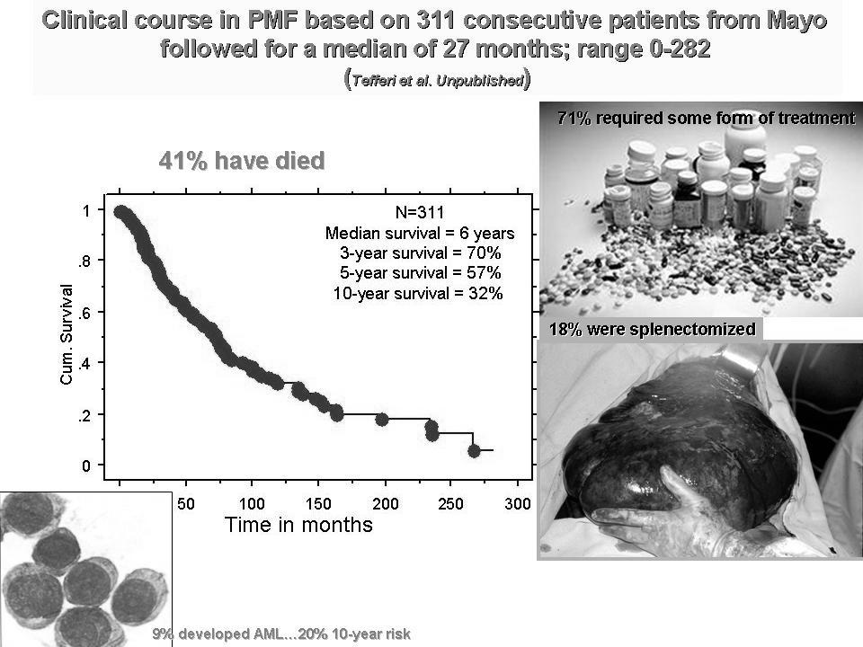 Consider transplant or Experimental therapy PMF-PS: Survival curves of prognostic groups per the new IPSS Survival by PMF-PS Consider 1.