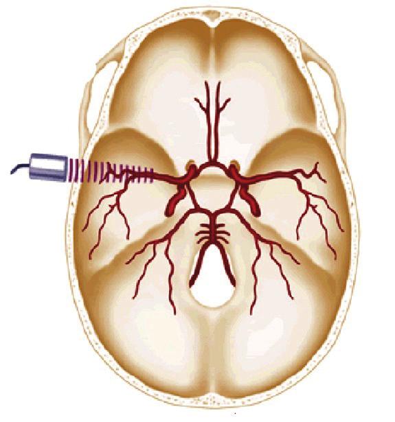 populacije ima urednu organizaciju Willisova kruga, dok su u ostalih prisutne manje ili više asimetrije, hipoplazije ili aplazije ogranaka ili cijelih krvnih žila mozga 9,10.