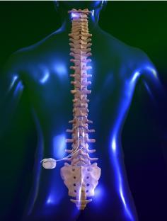 Neurostimulation Failed back surgery syndrome : + (low to