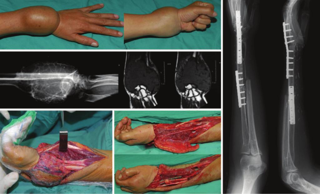 (c) Intra-operative photograph showing bony defect post-wide resection of left distal radius tumour. (d) Wrist reconstruction with non-vascularised proximal fibular graft.