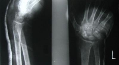 One patient with lunate dislocation absconded when offered open reduction when he presented two weeks after injury. The other seven patients were followed up for 8 months.