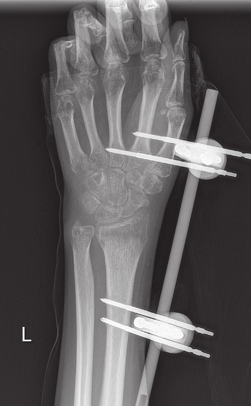 It is a Lichtman stage II disease, where the outline is normal, but definite density changes are present within the lunate. Operative treatment with volar wrist approach was performed.