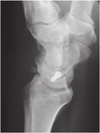After verification under fluoroscopy of the appropriate placement of the pins, the wrist was replaced on traction and the pins were drilled into the lunate. A cannulated screw (2.